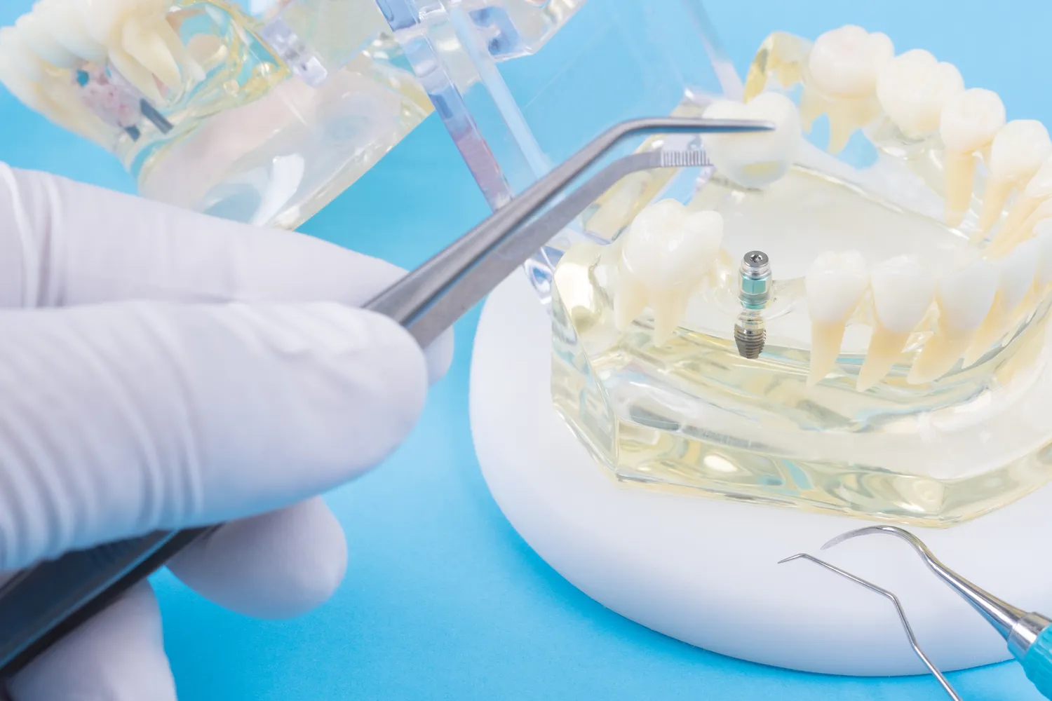 Implanty gdzie najlepiej opinie?