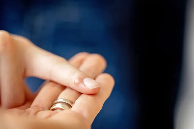 Jak leczyć kurzajki?