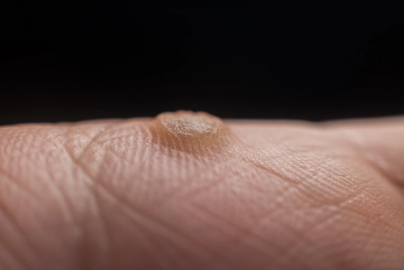 Z czego robią się kurzajki?