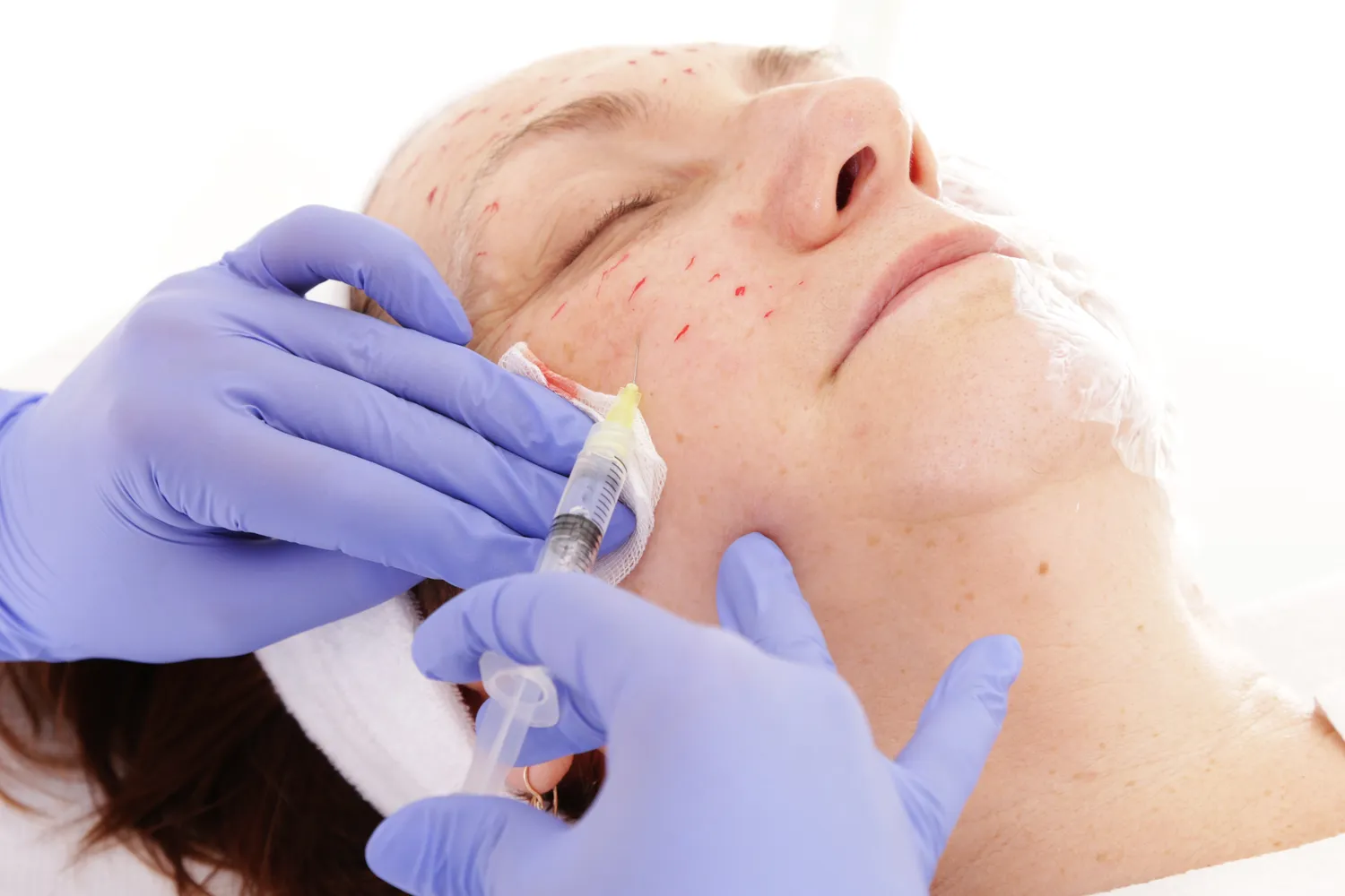 Ile kosztuje kwas hialuronowy na usta?